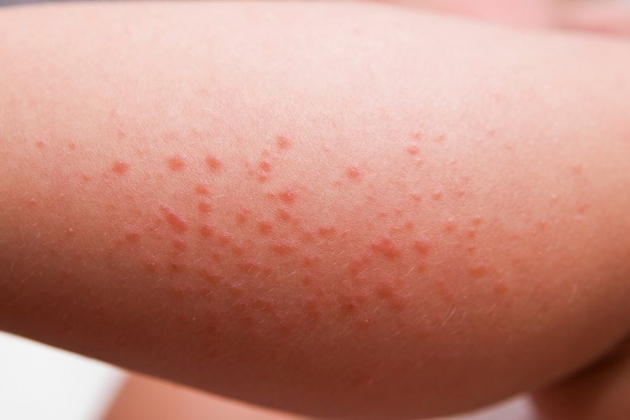 Allergies/Hives (Urticaria)/Rashes